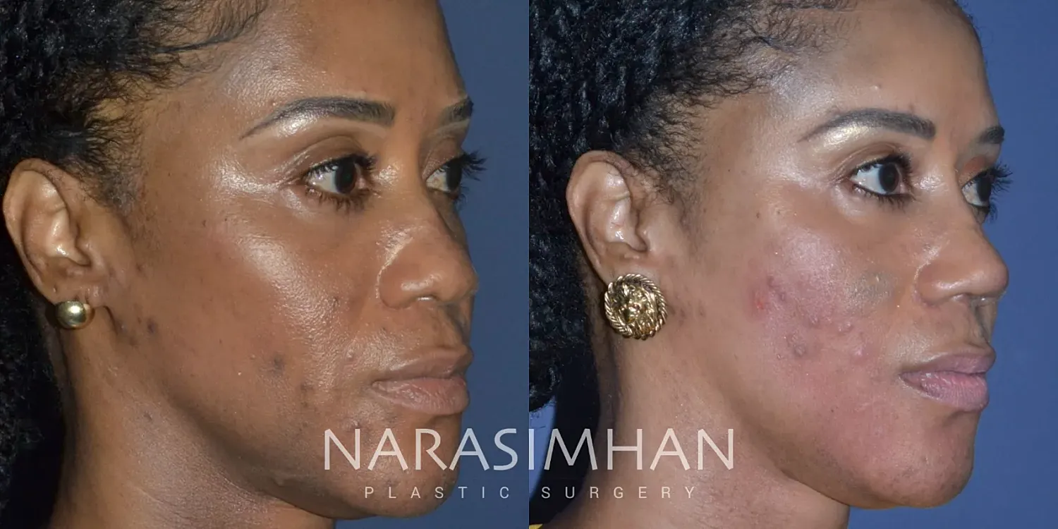 Rhinoplasty Before & After