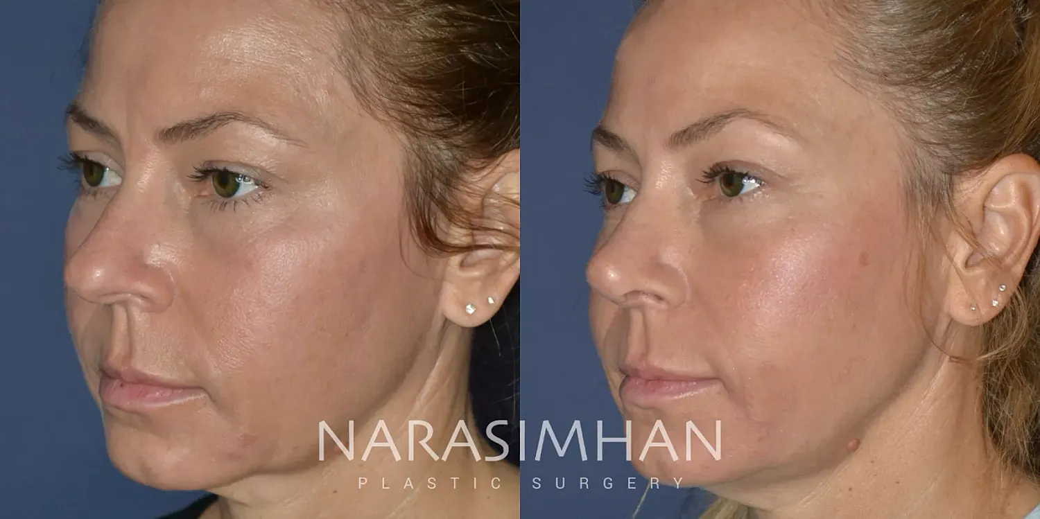 Rhinoplasty Before & After