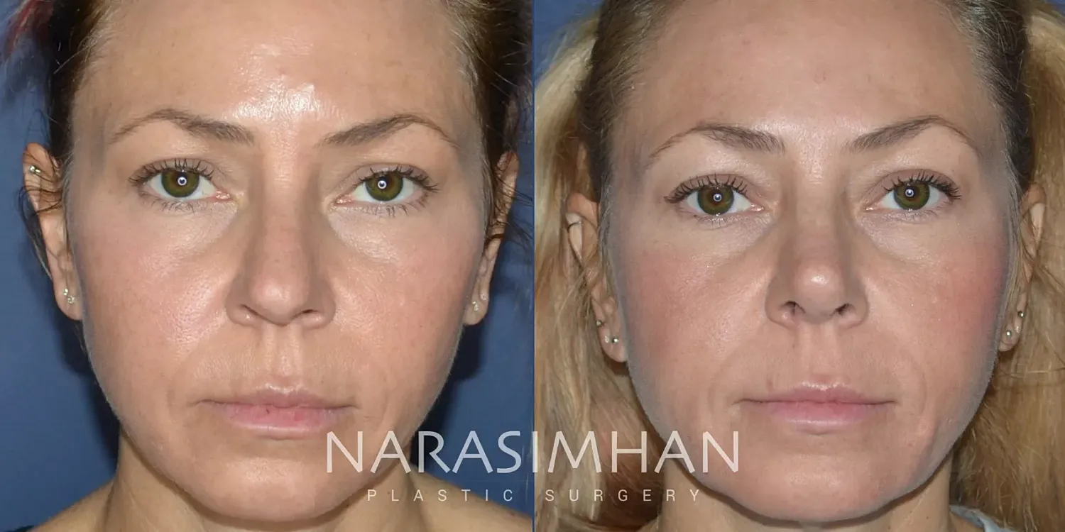 Rhinoplasty Before & After