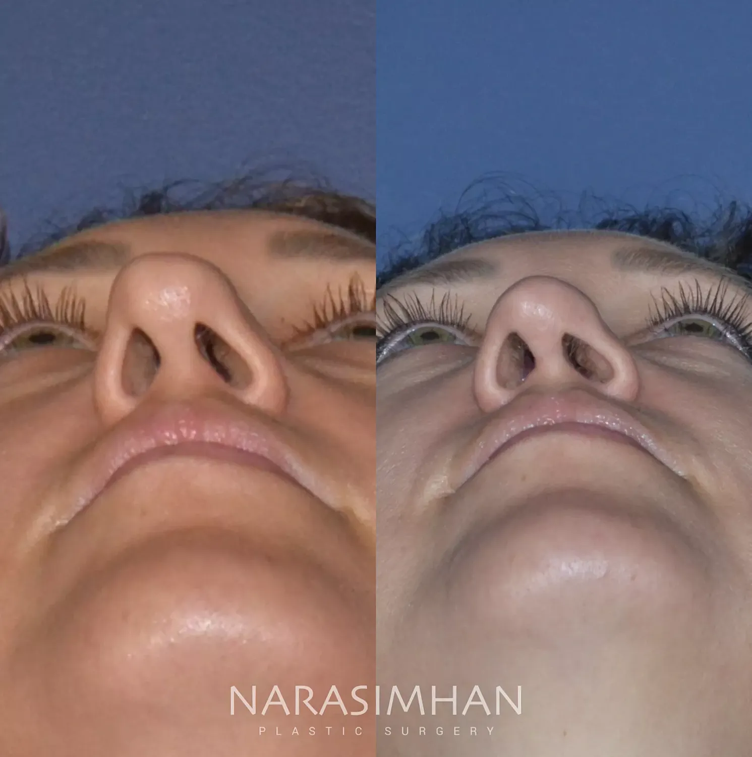 Rhinoplasty Before & After