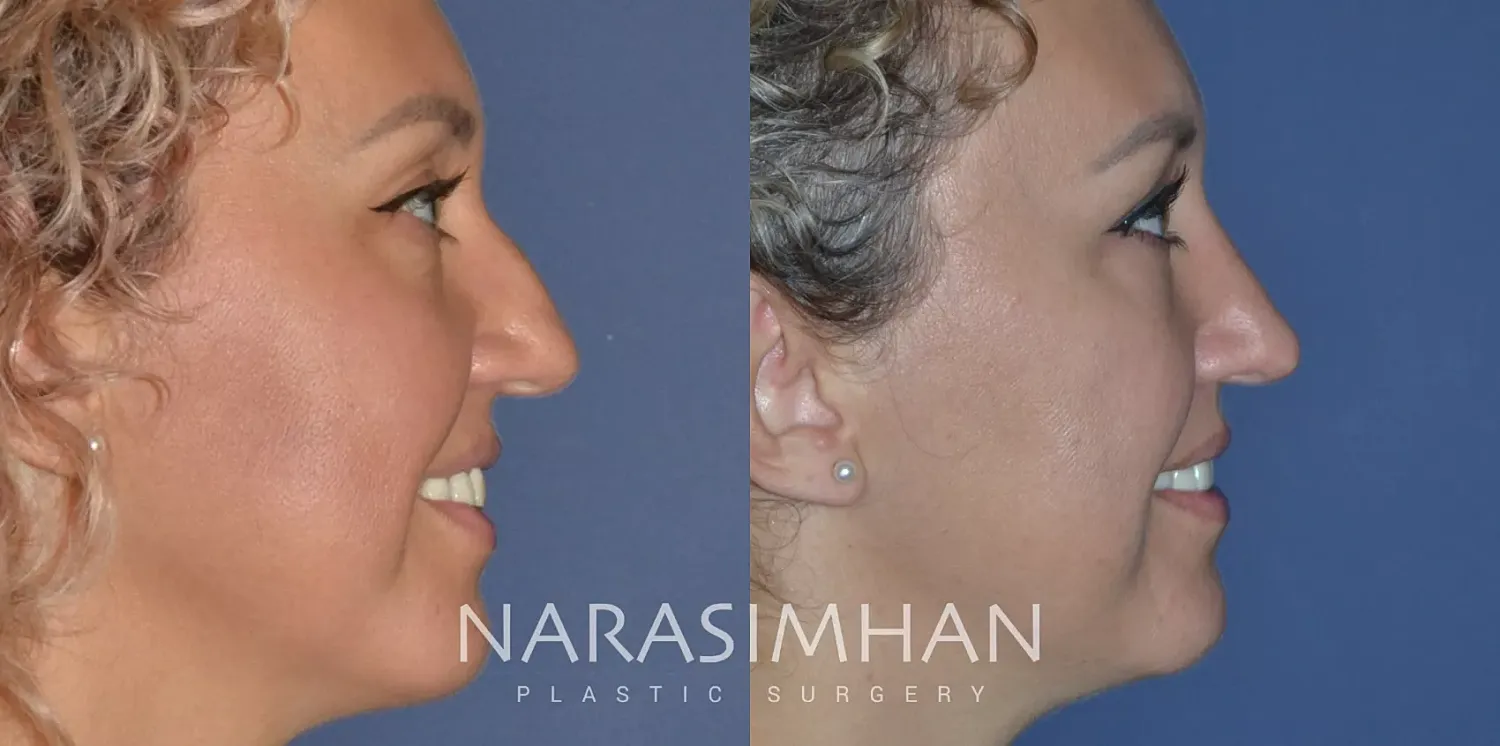 Rhinoplasty Before & After