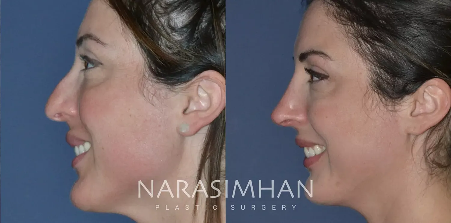 Rhinoplasty Before & After