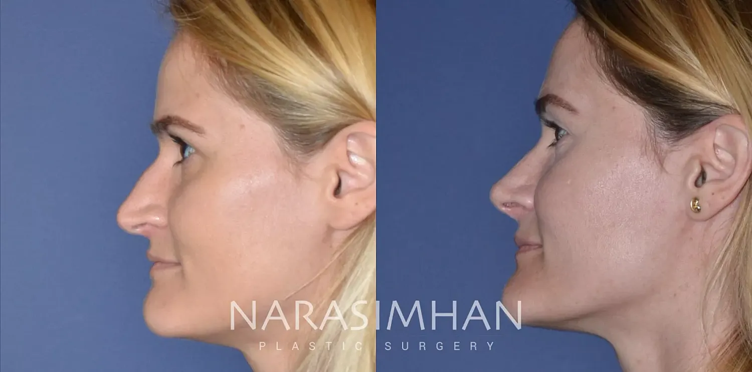 Rhinoplasty Before & After