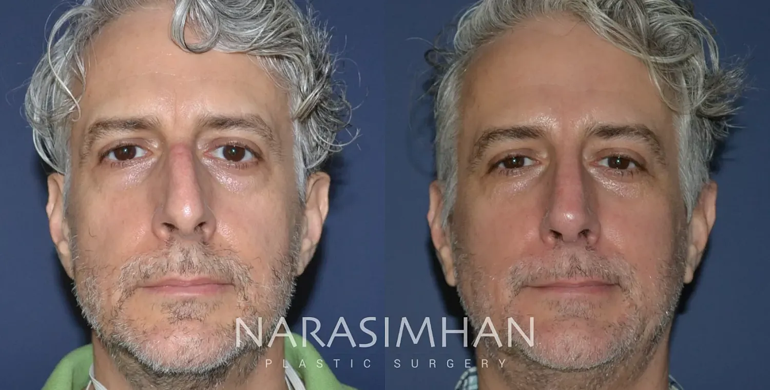 Rhinoplasty Before & After
