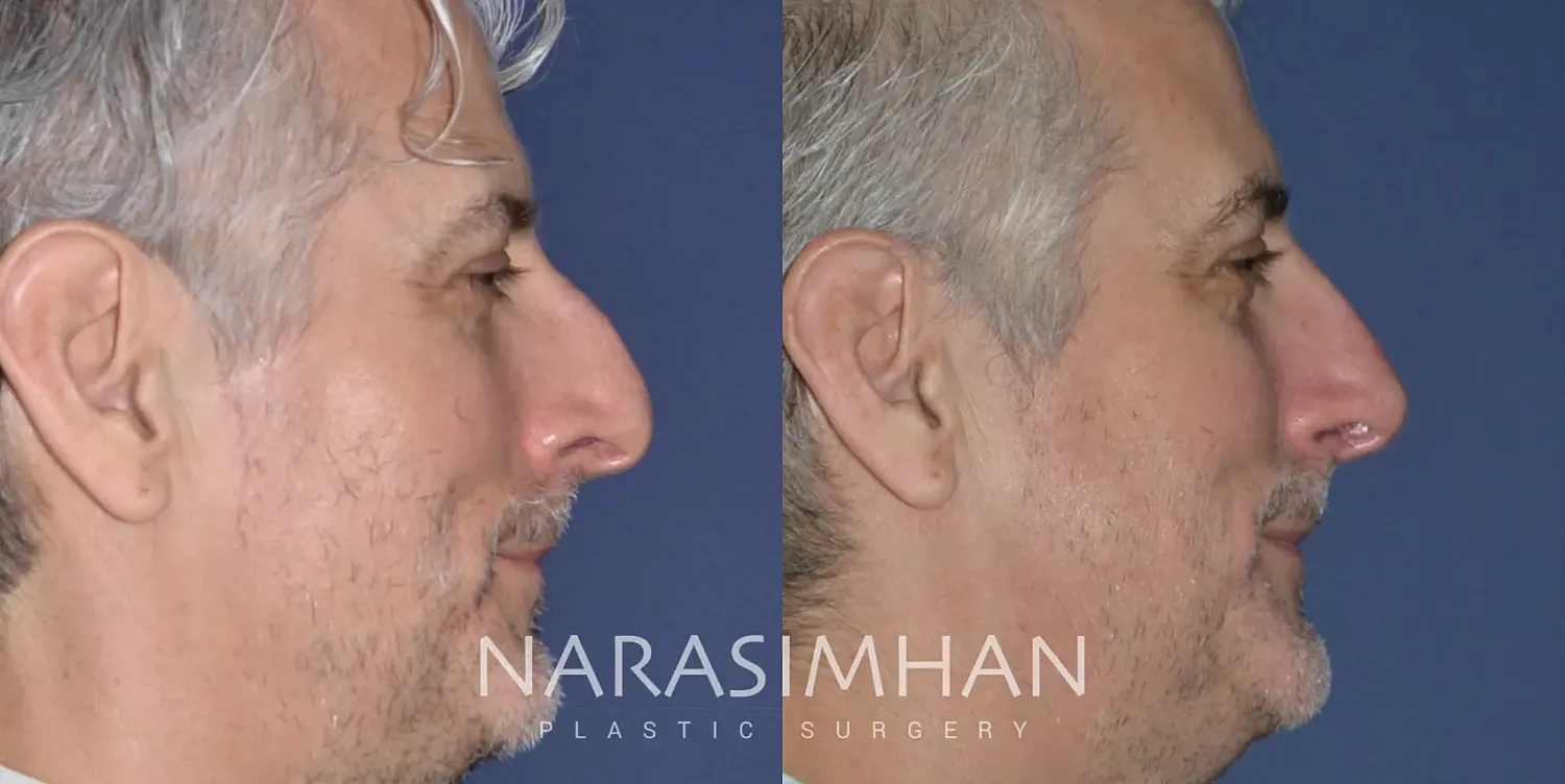 Rhinoplasty Before & After
