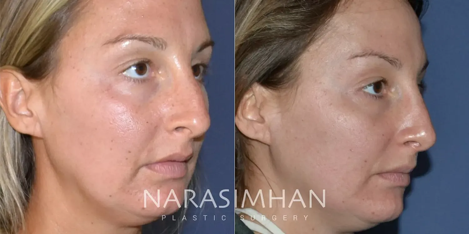 Rhinoplasty Before & After