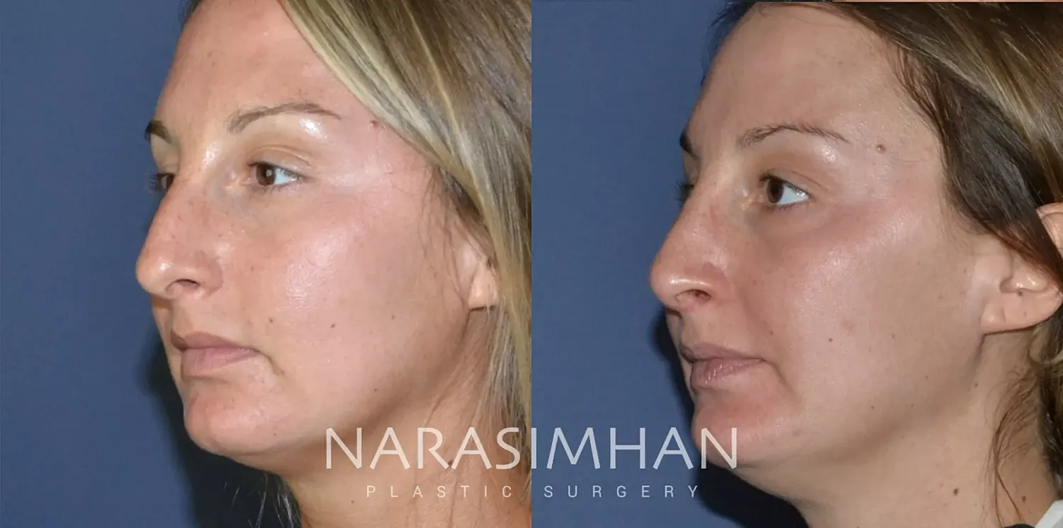 Rhinoplasty Before & After