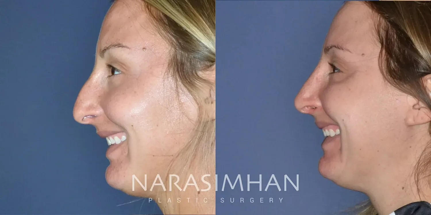 Rhinoplasty Before & After