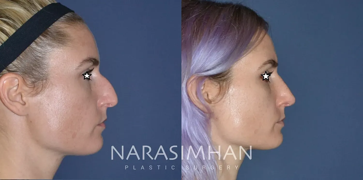 Rhinoplasty Before & After