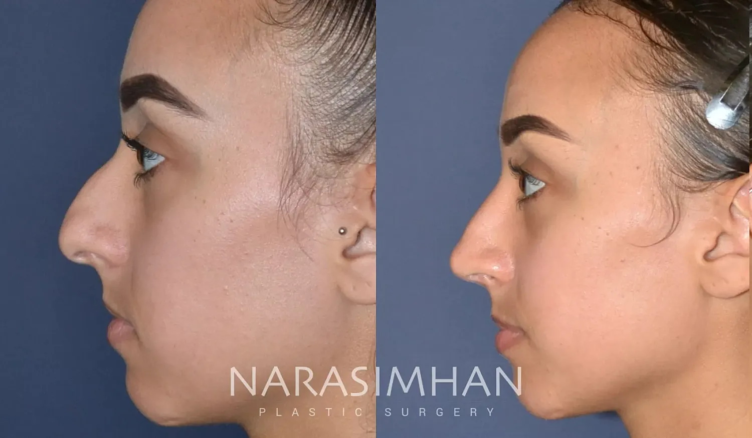 Rhinoplasty Before & After