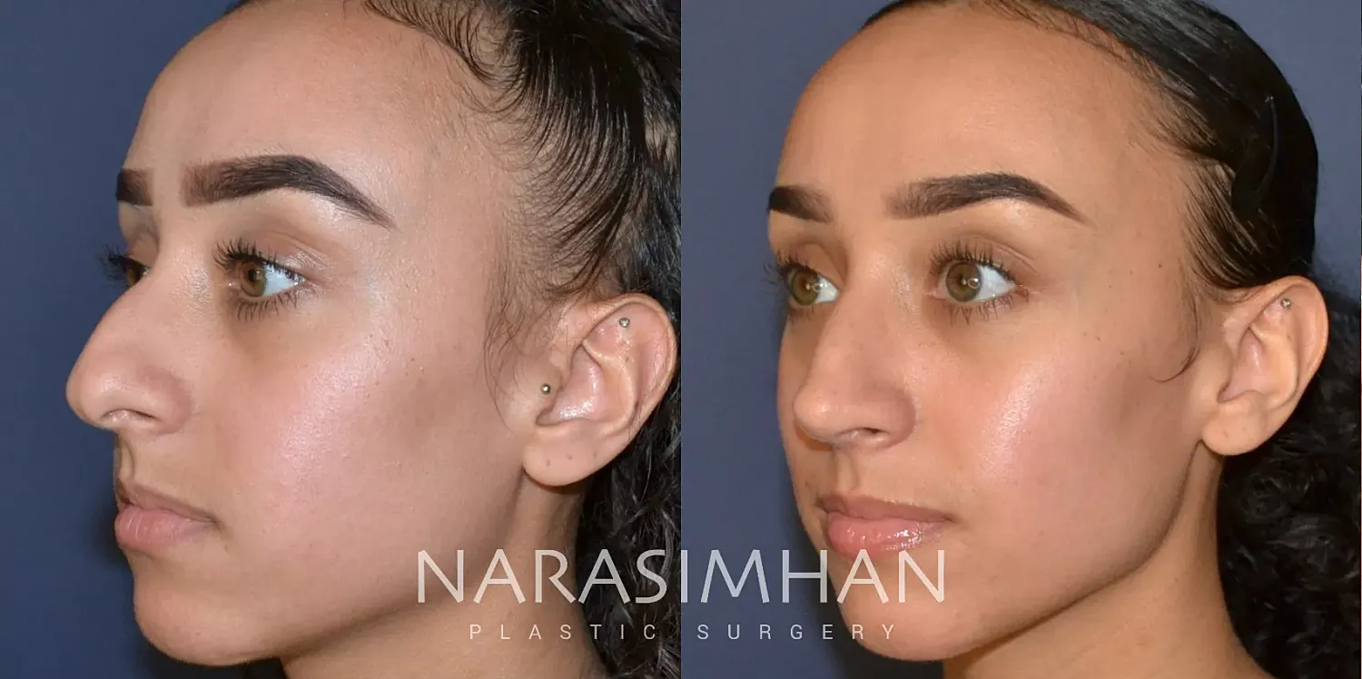 Rhinoplasty Before & After