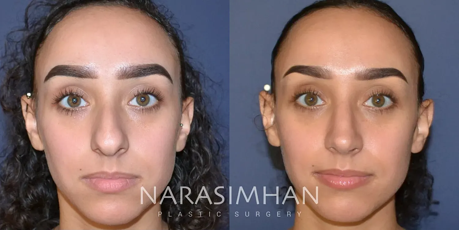 Rhinoplasty Before & After