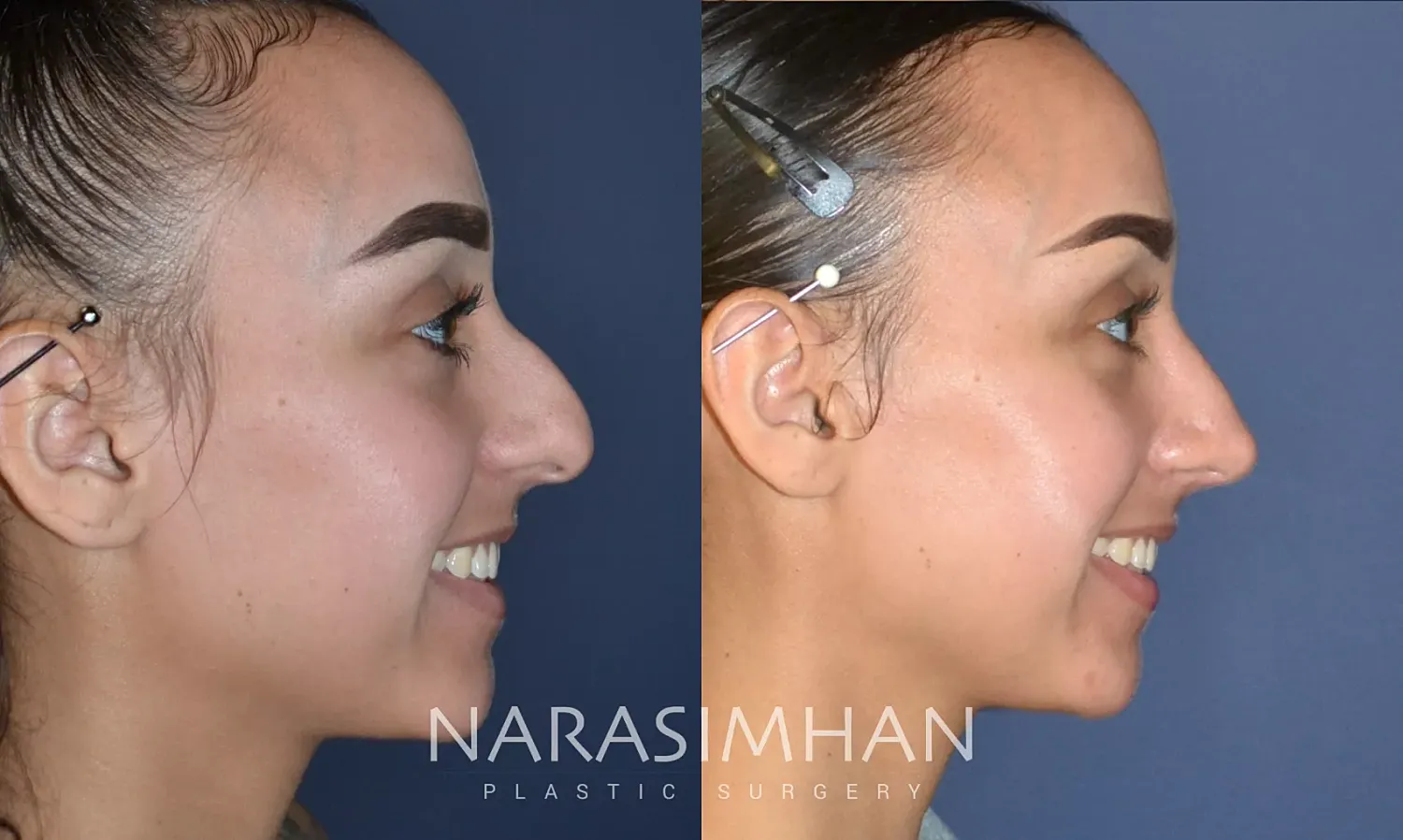 Rhinoplasty Before & After