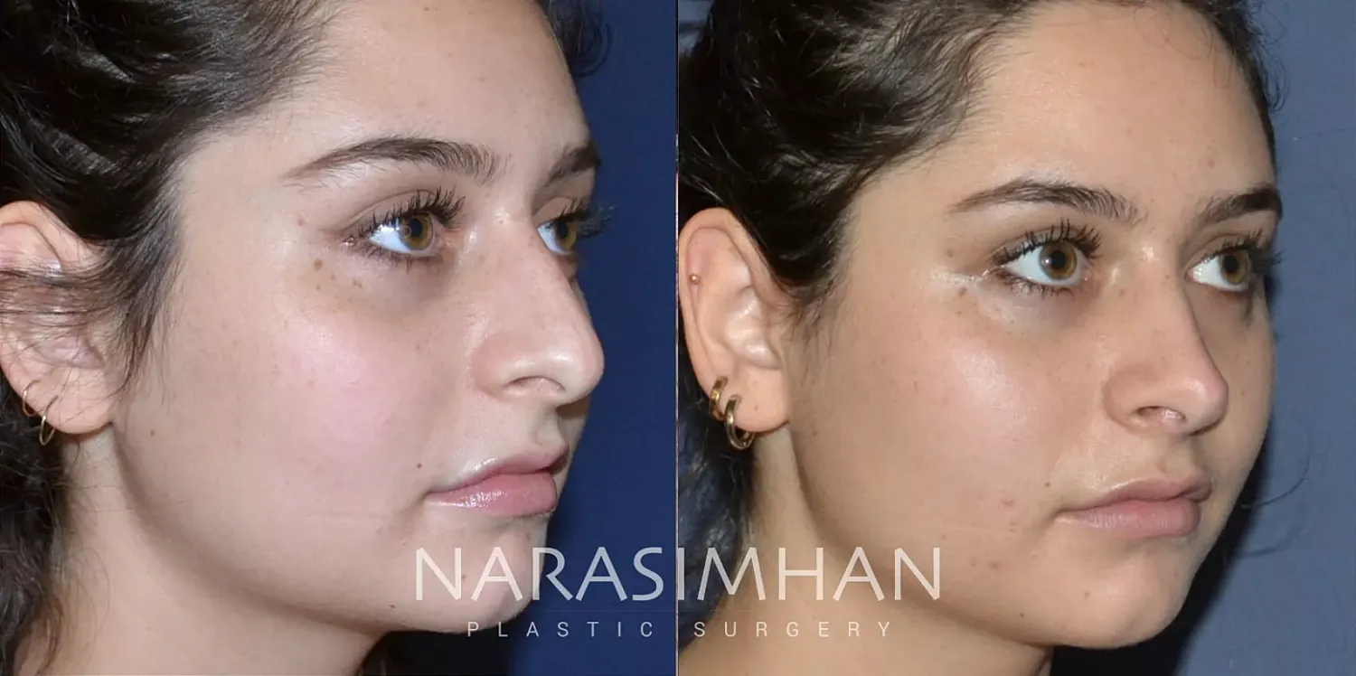 Rhinoplasty Before & After