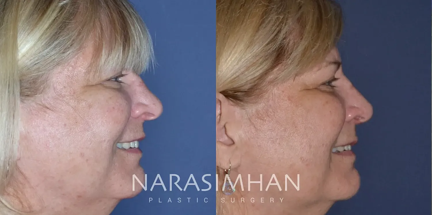 Rhinoplasty Before & After