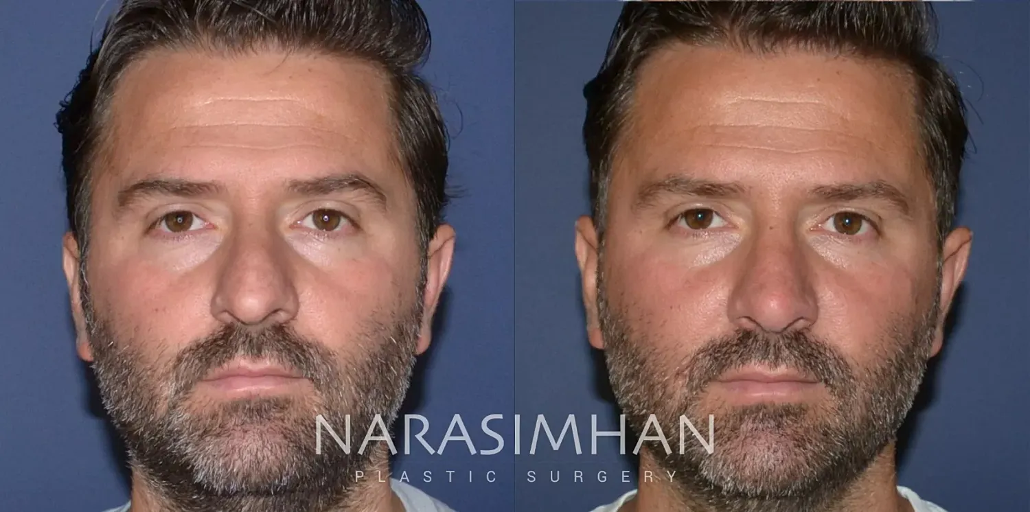 Rhinoplasty Before & After
