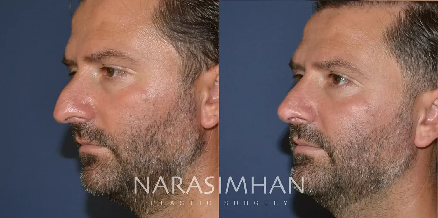 Rhinoplasty Before & After