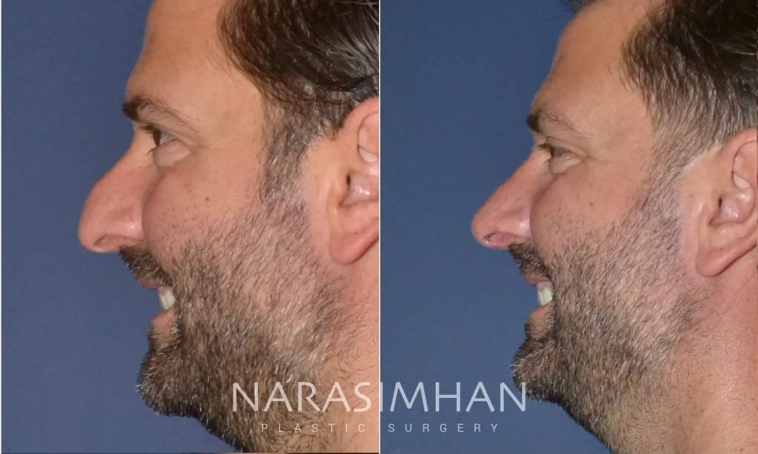Rhinoplasty Before & After