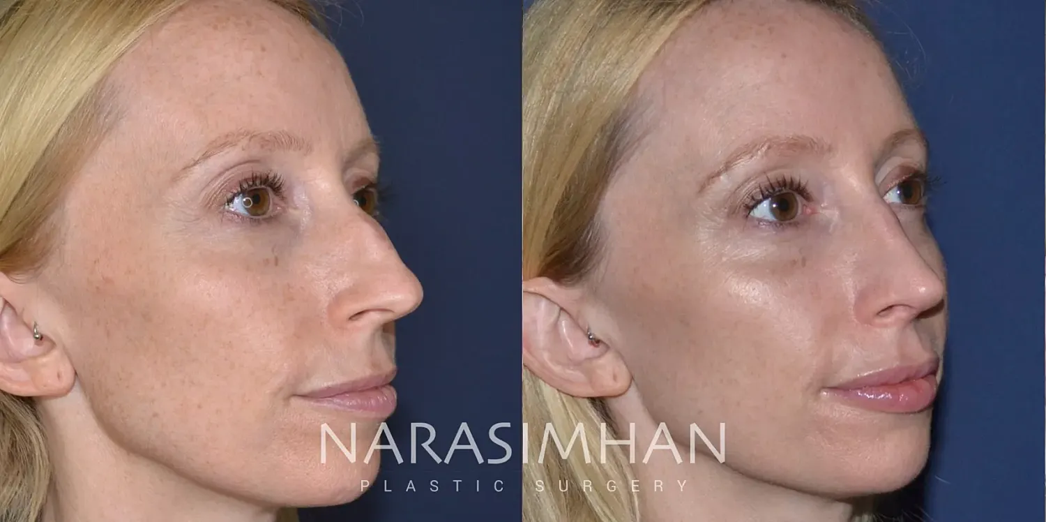Rhinoplasty Before & After