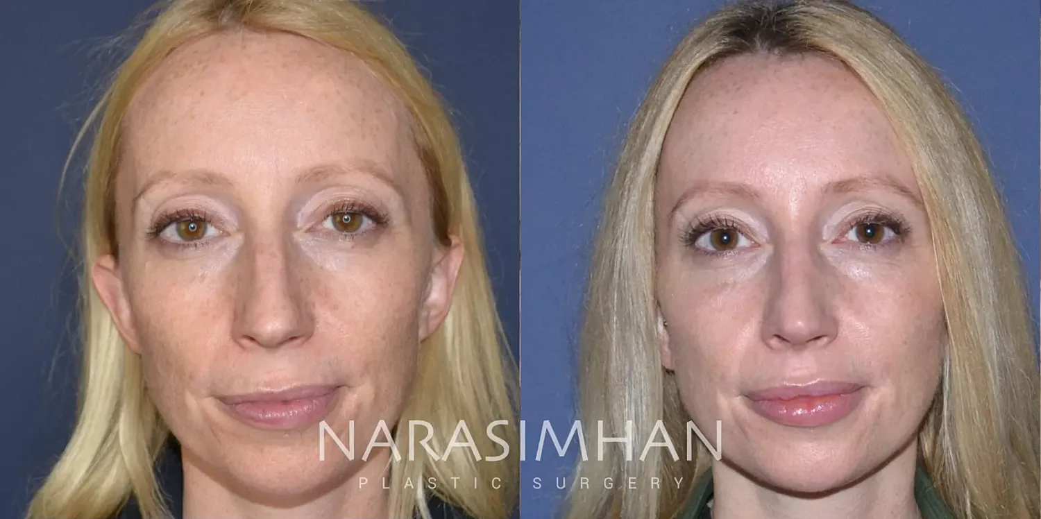 Rhinoplasty Before & After