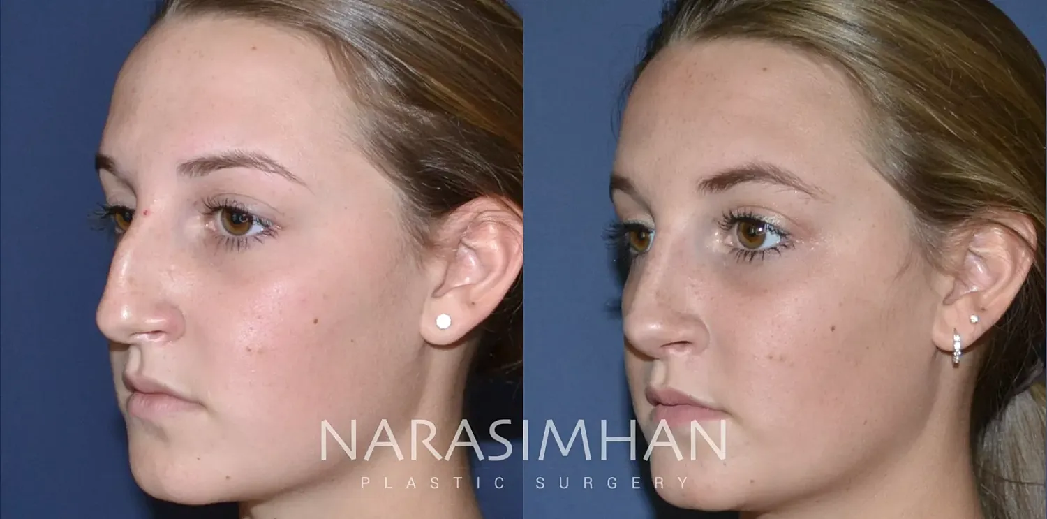 Rhinoplasty Before & After
