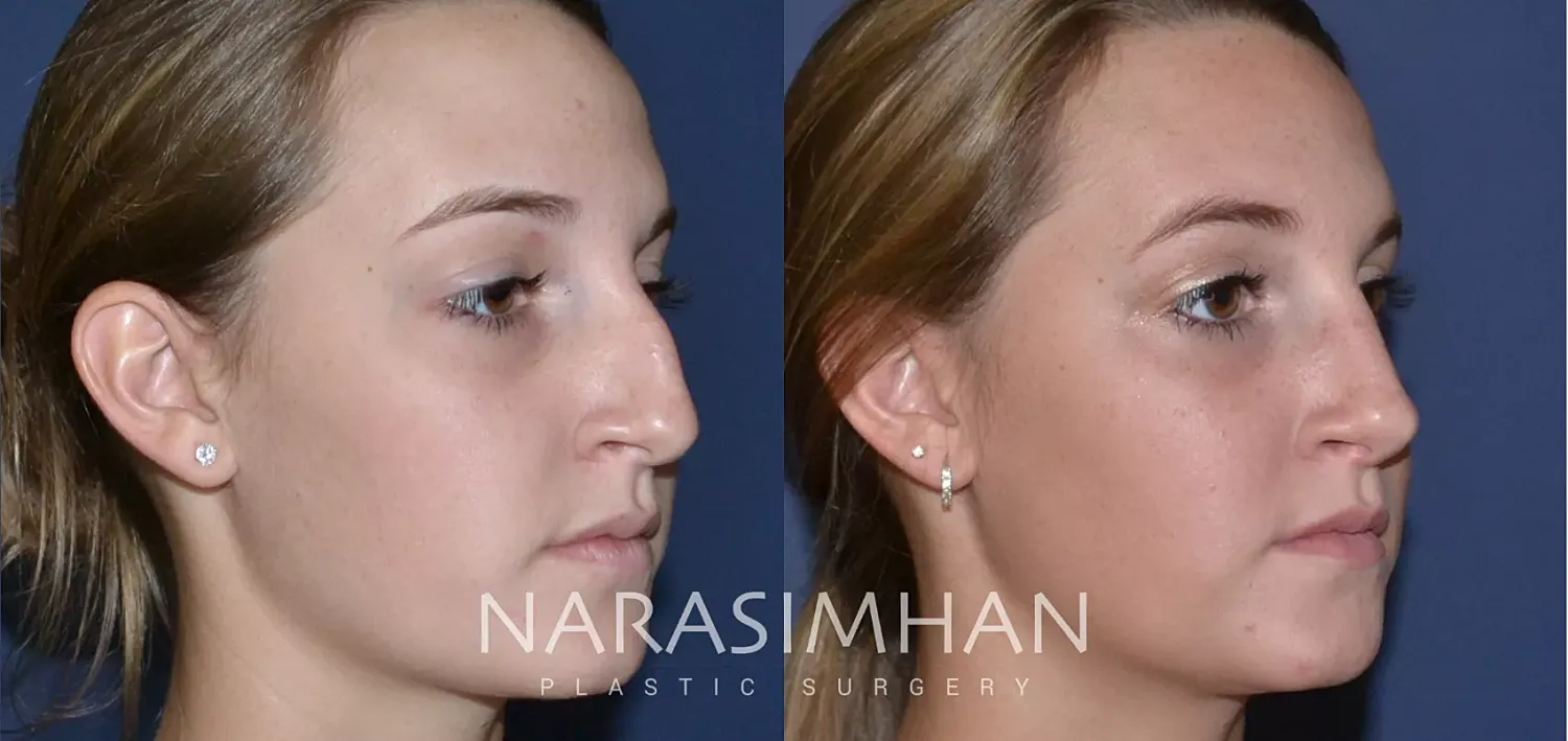 Rhinoplasty Before & After