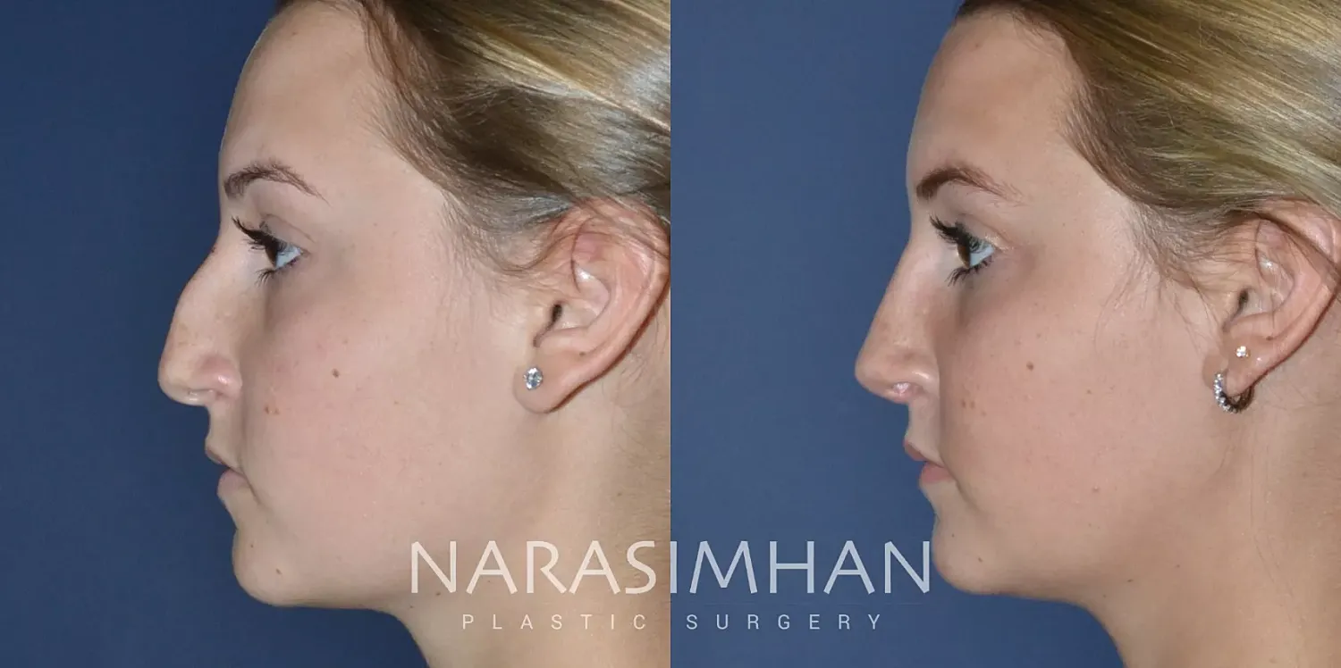 Rhinoplasty Before & After