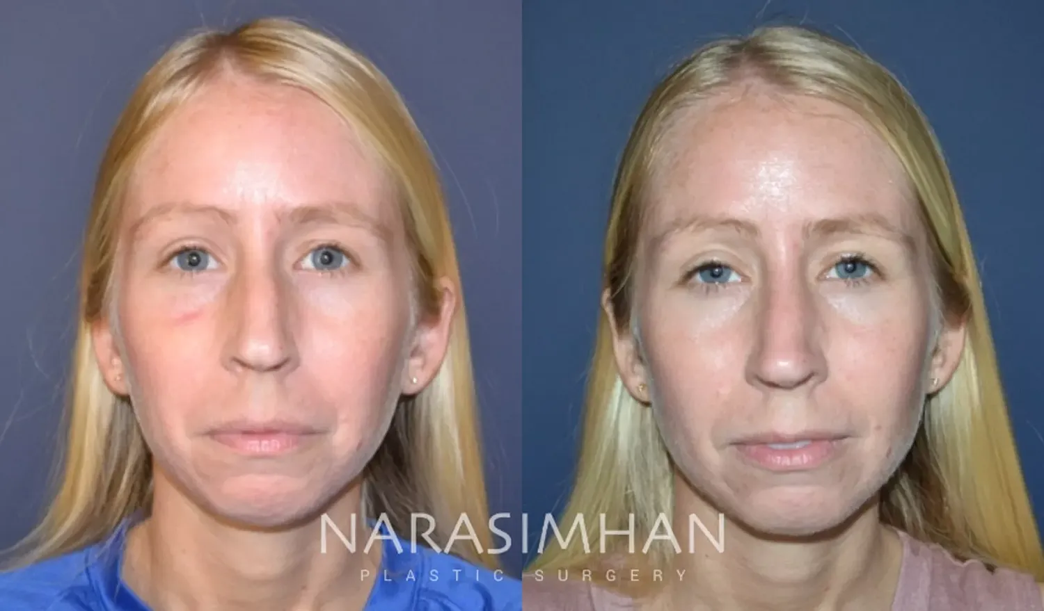 Rhinoplasty Before & After