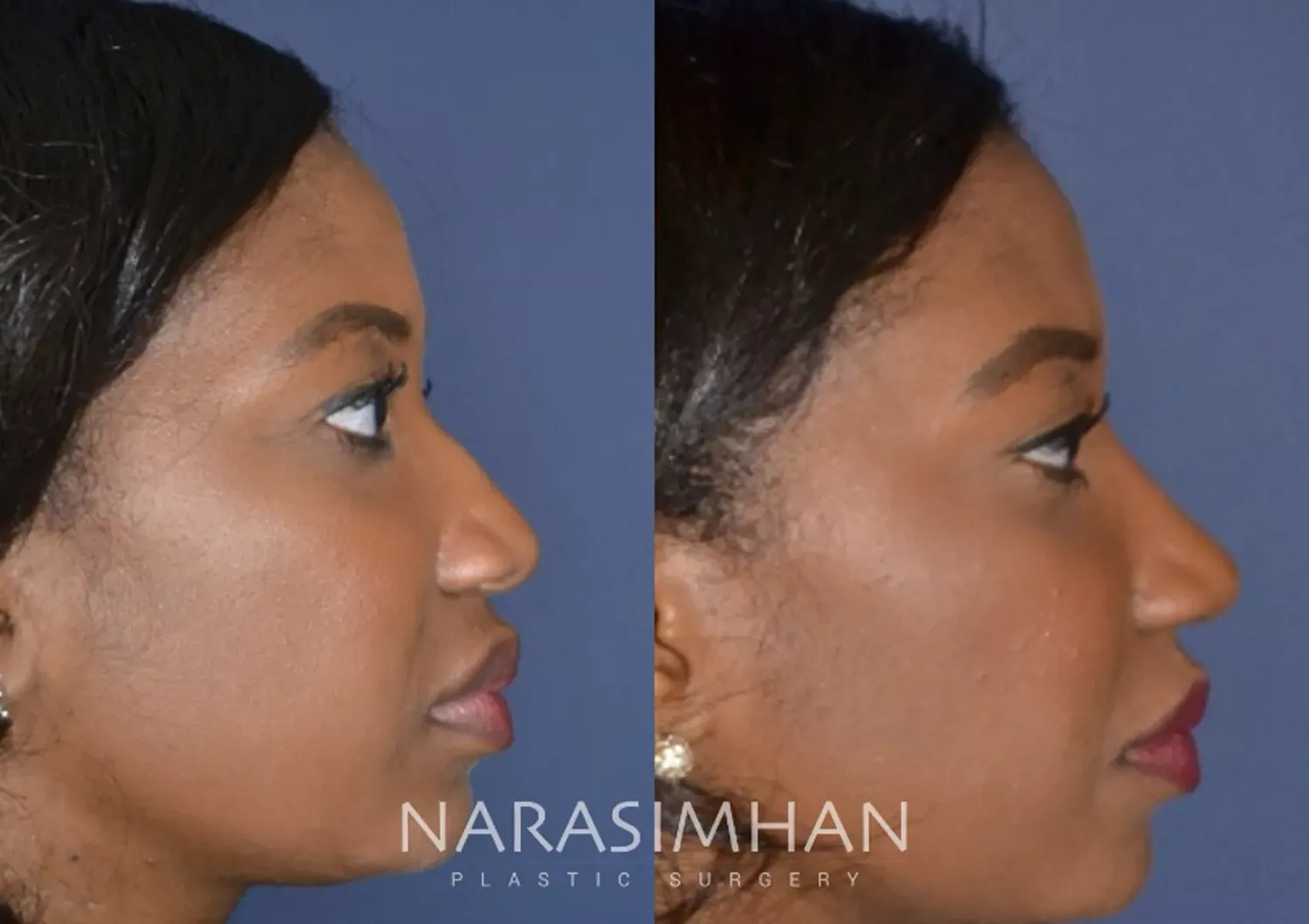 Rhinoplasty Before & After