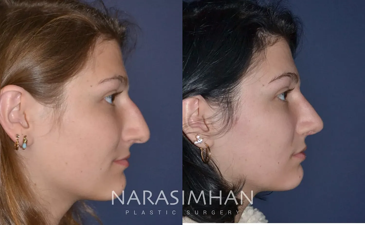 Rhinoplasty Before & After