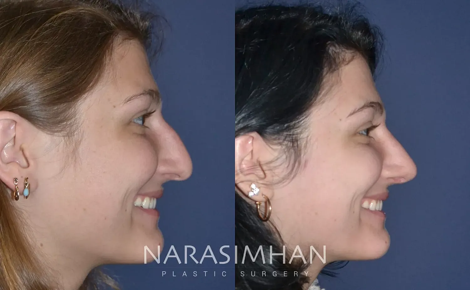 Rhinoplasty Before & After