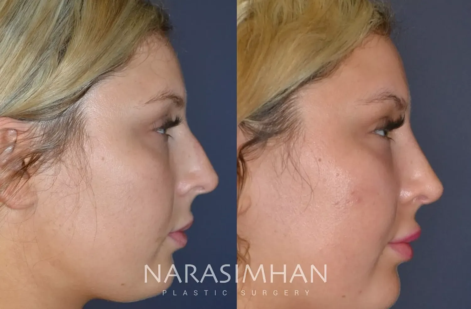 Rhinoplasty Before & After
