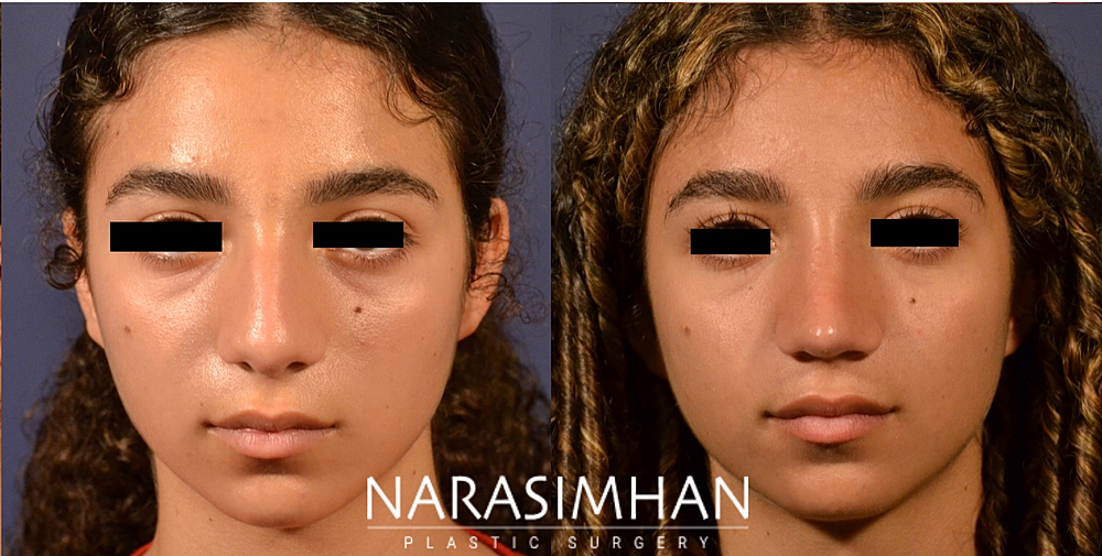 Rhinoplasty Before & After