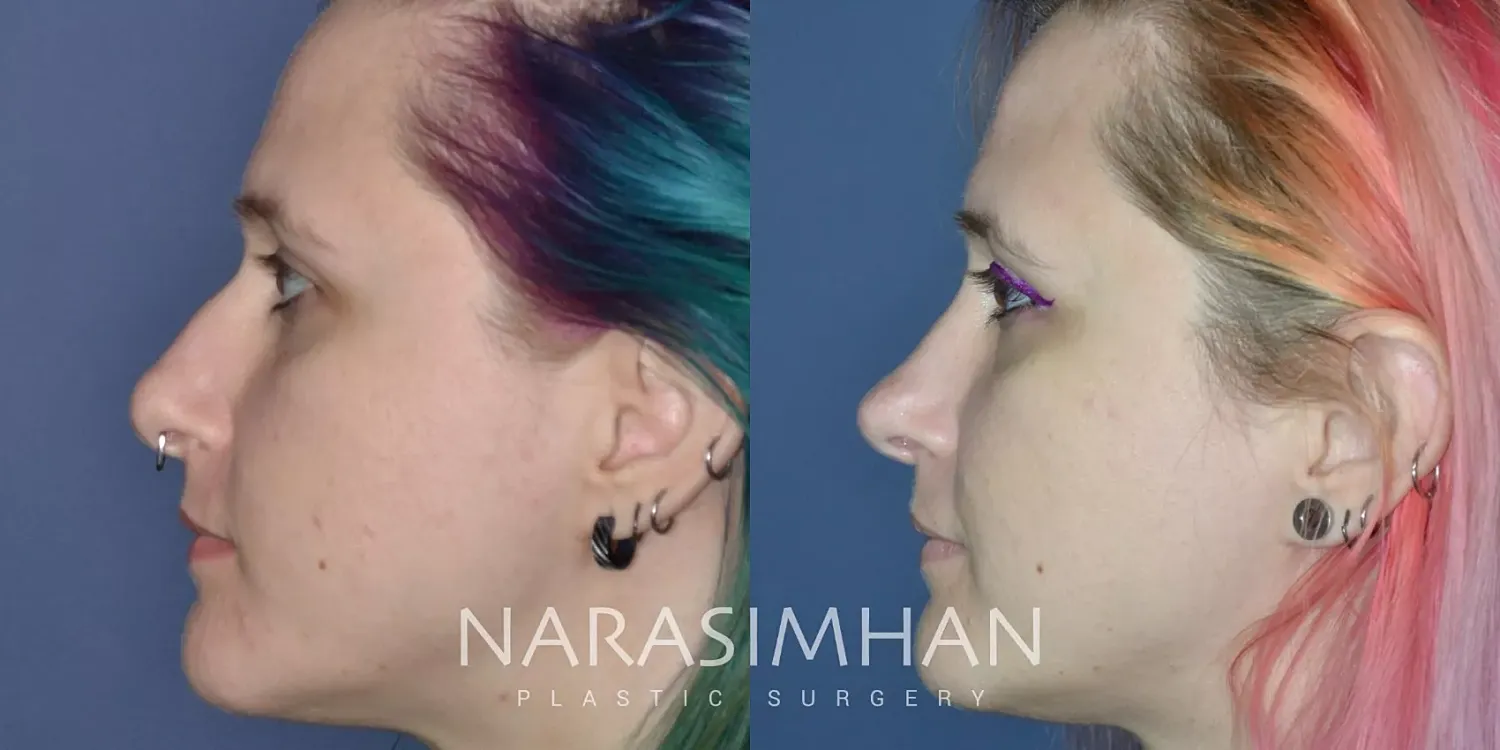 Rhinoplasty Before & After
