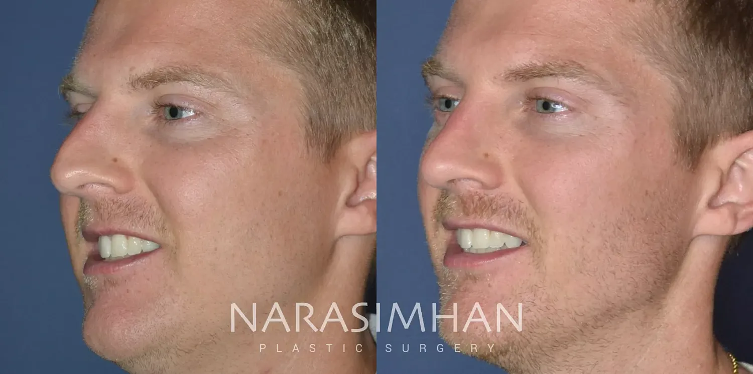 Rhinoplasty Before & After