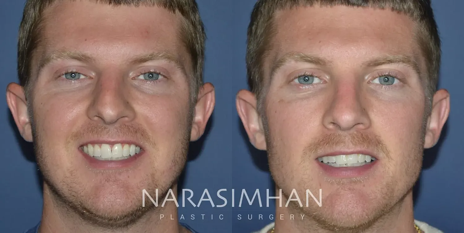 Rhinoplasty Before & After