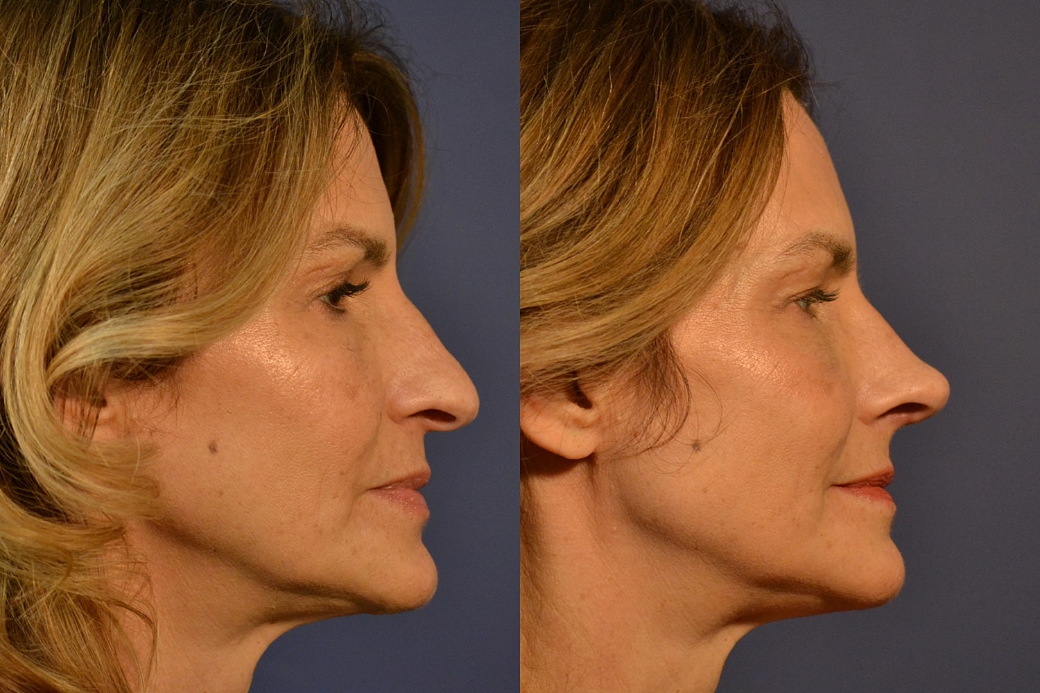 Rhinoplasty Before & After