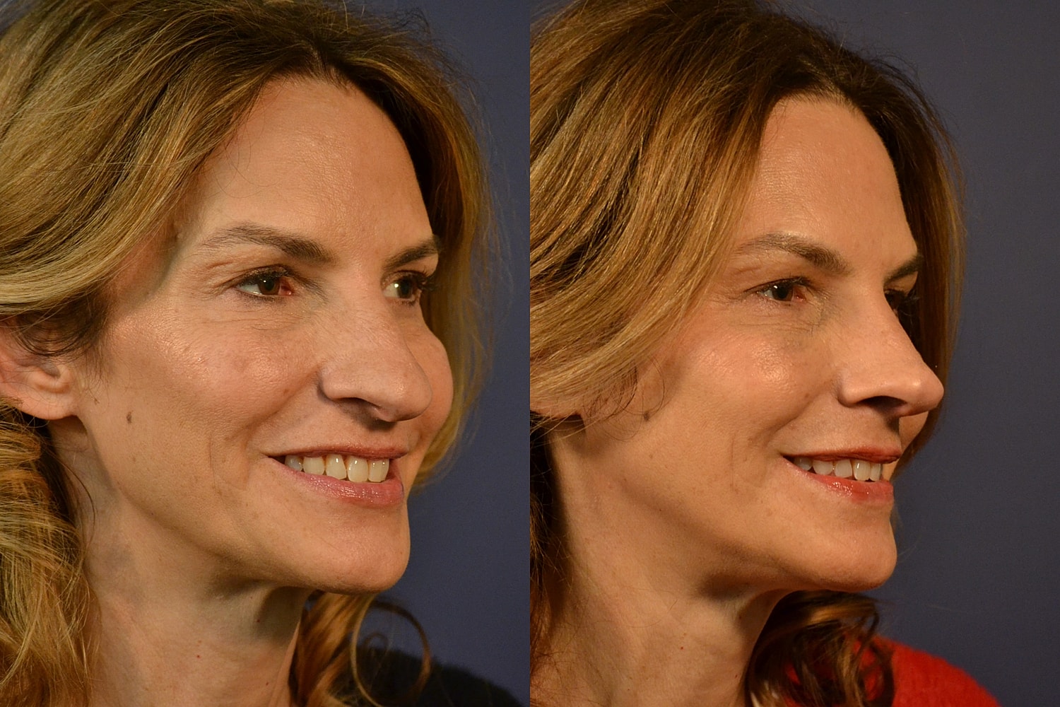 Rhinoplasty Before & After