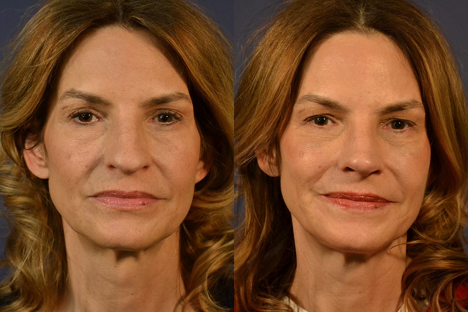 Rhinoplasty Before & After