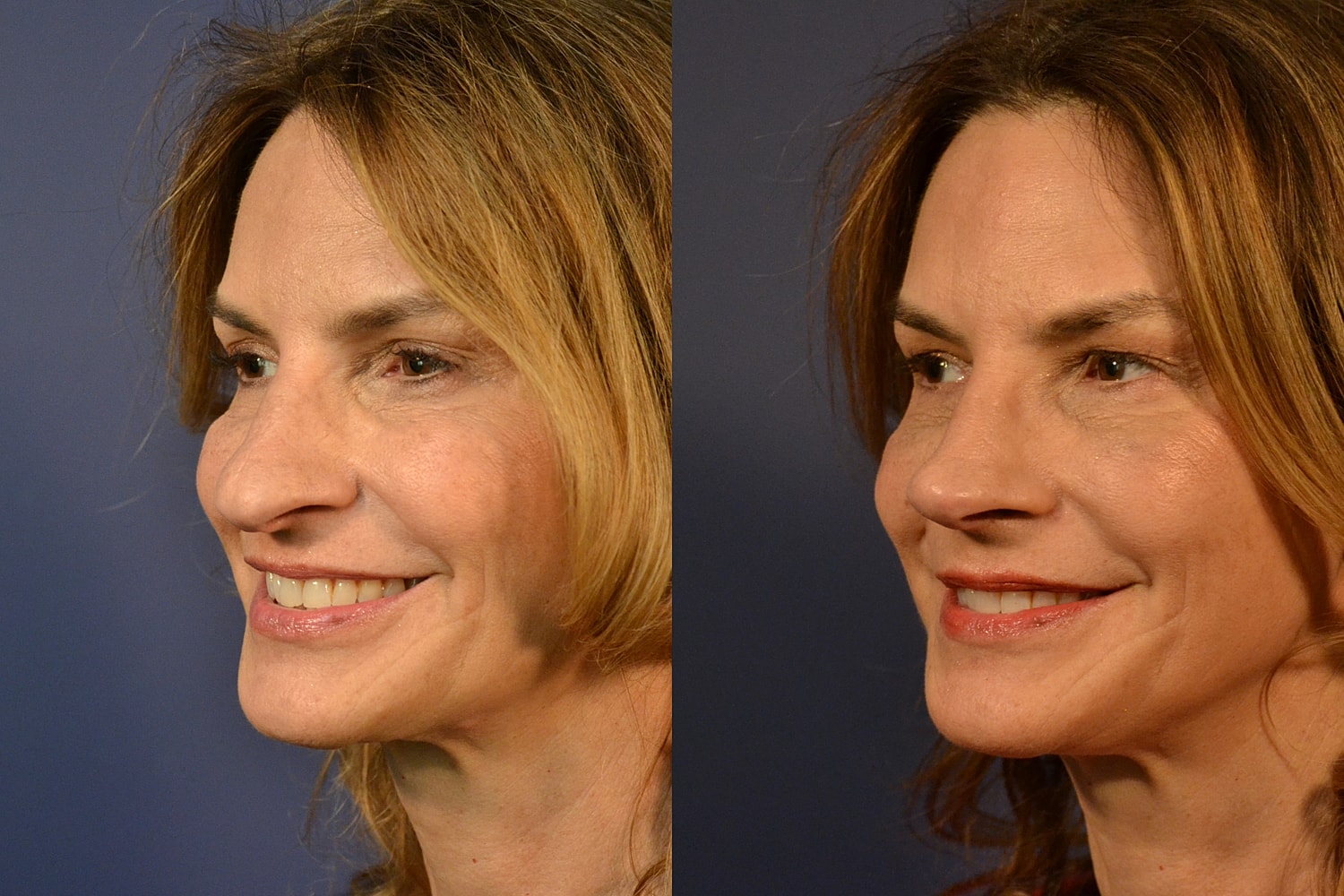 Rhinoplasty Before & After