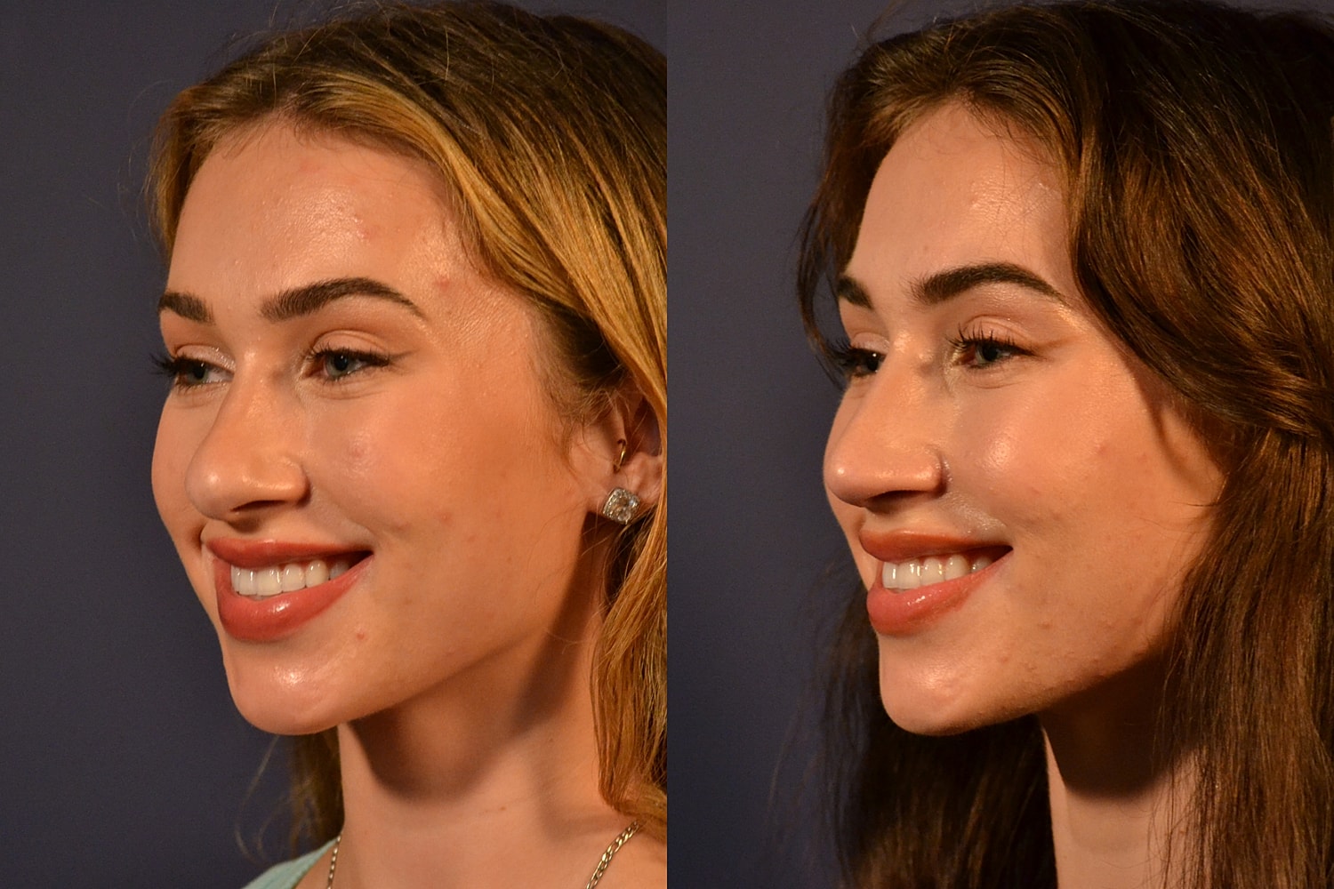 Side profile comparison of two smiling individuals.