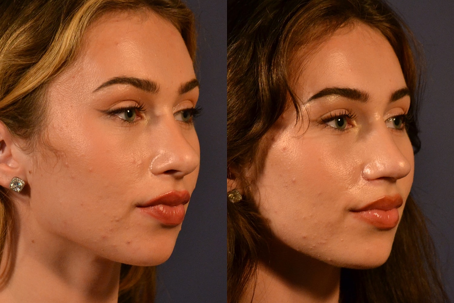 Before and after beauty treatment portraits.