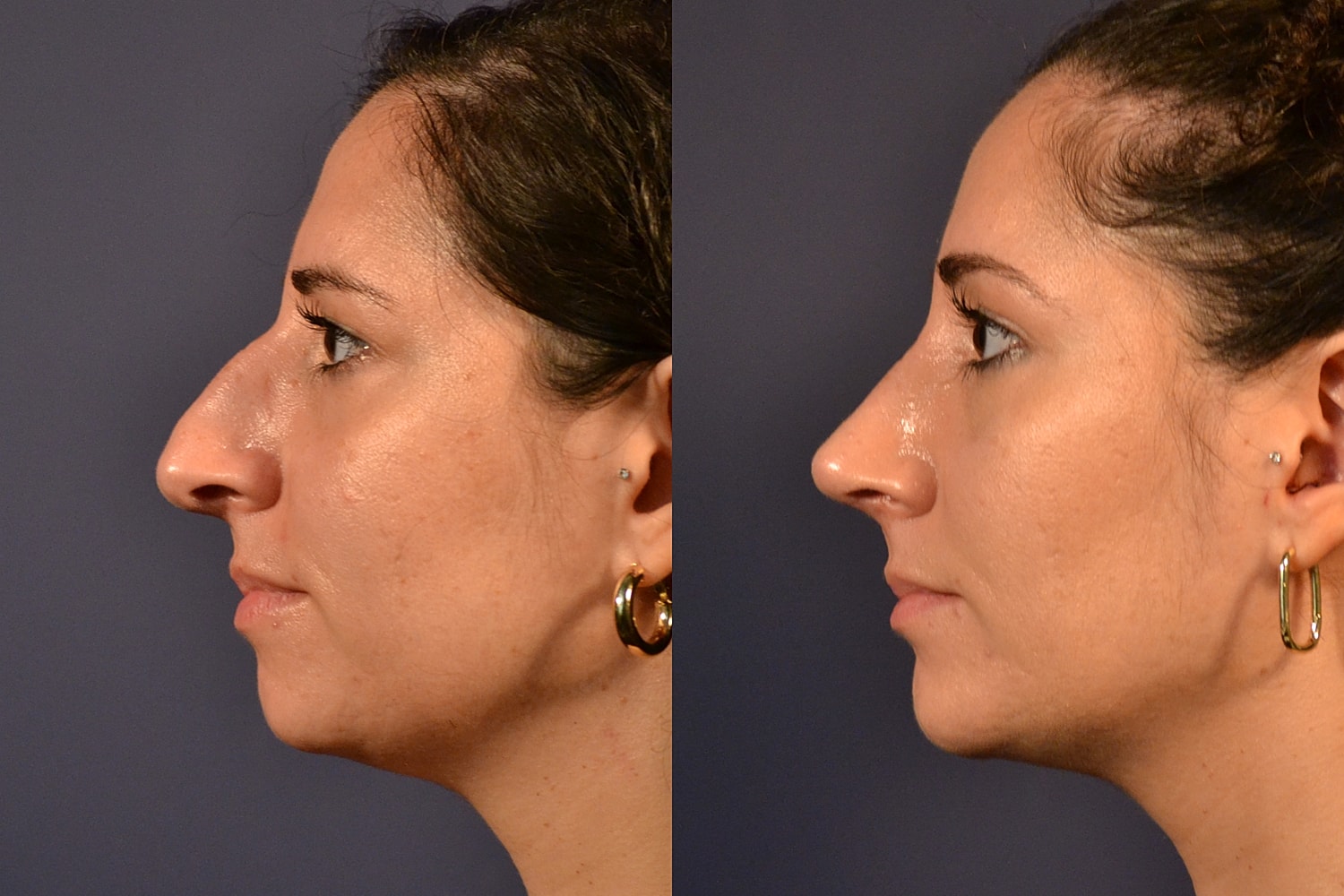 Before and after profile view of a nose.
