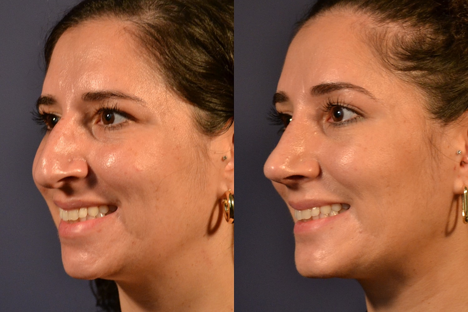 Before and after facial cosmetic procedure comparison.