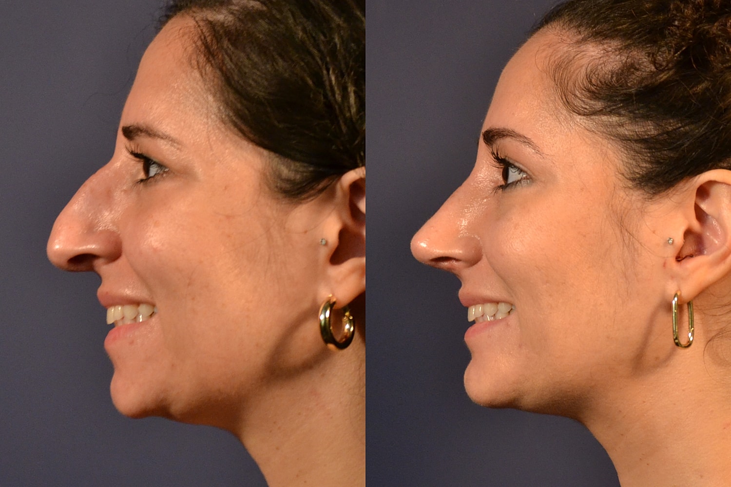 Before and after nose profile comparison image.