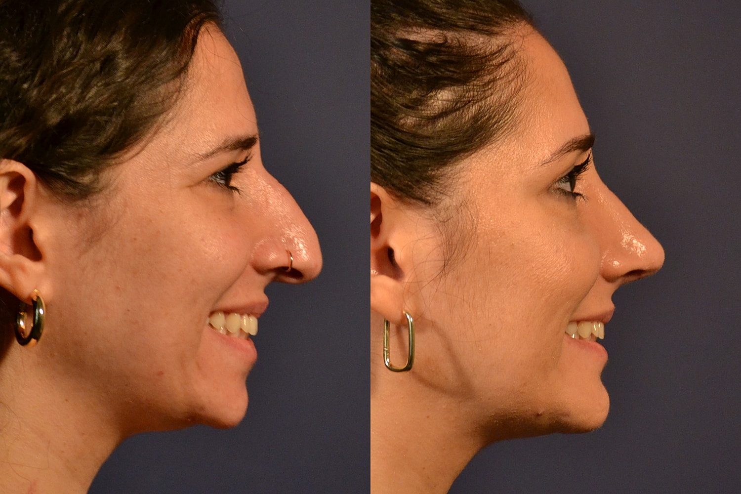 Before and after profile view of a nose.
