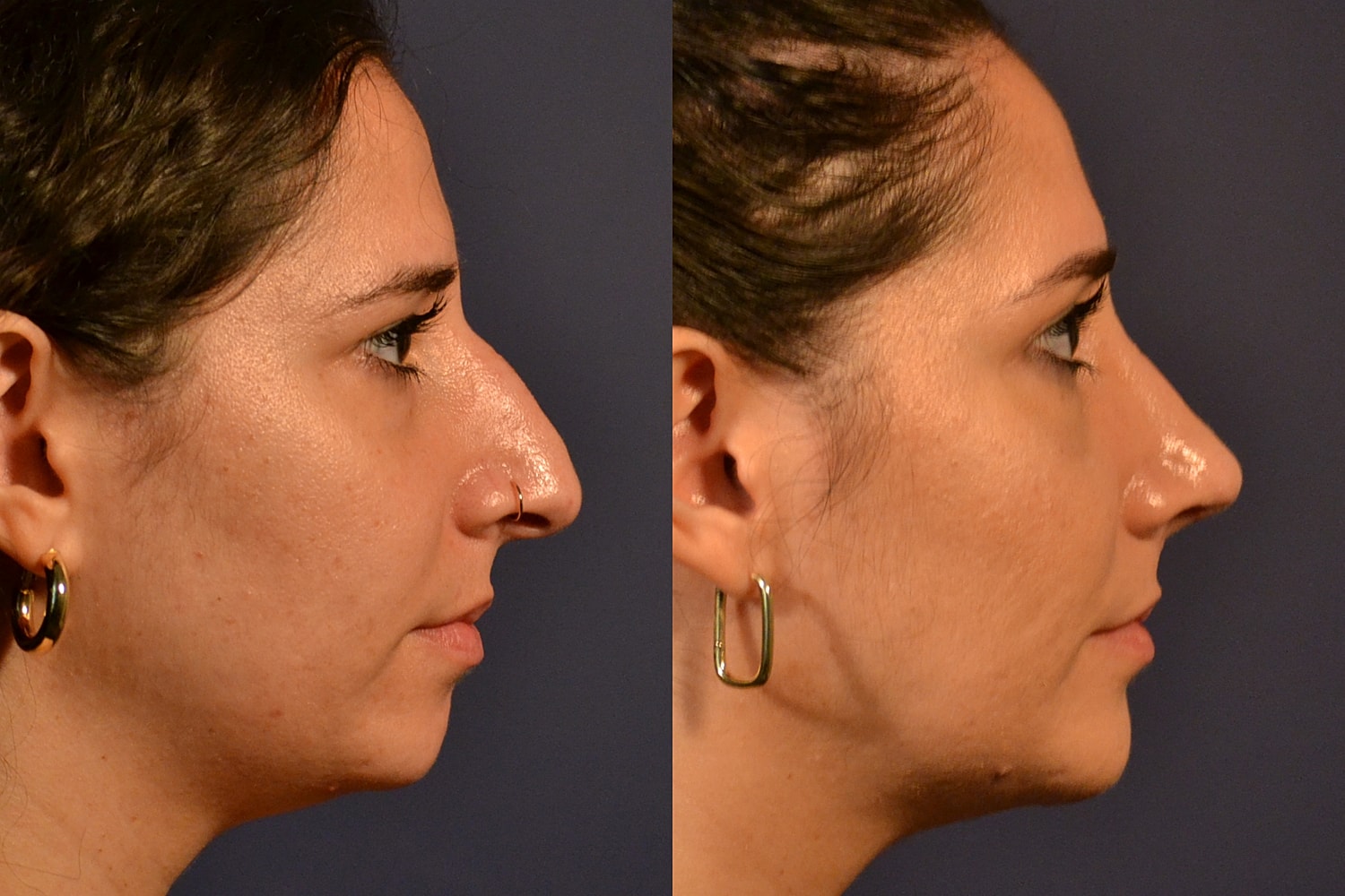Profile comparison before and after nose surgery