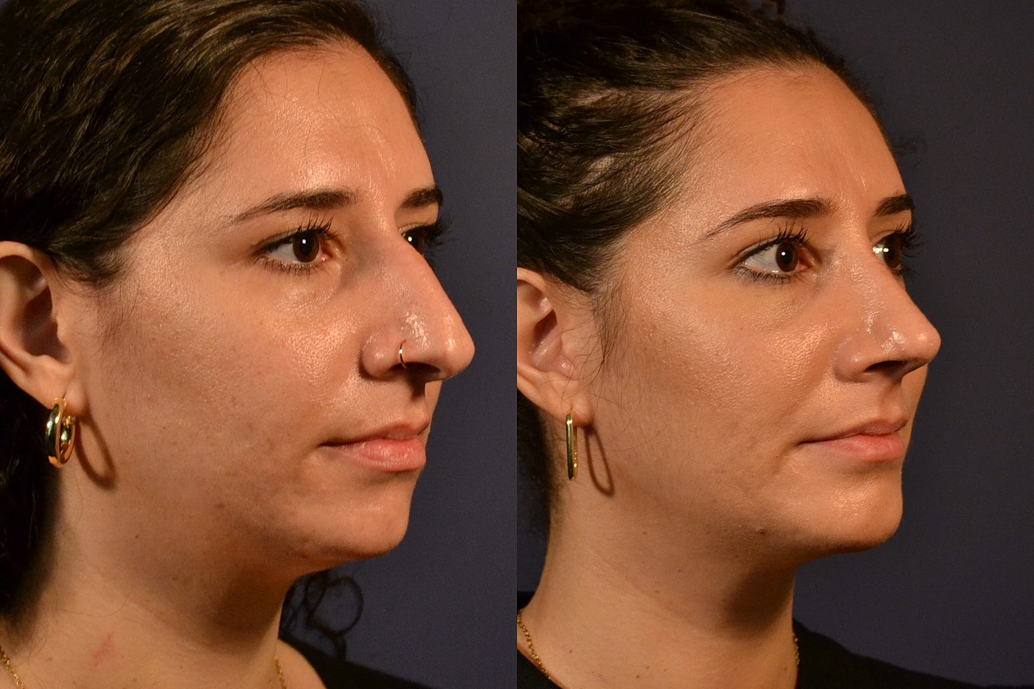 Side profile comparison of a woman's face.