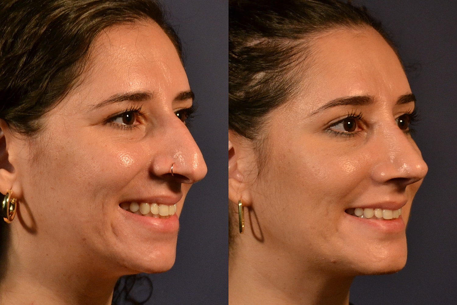 Profile comparison before and after aesthetic treatment.