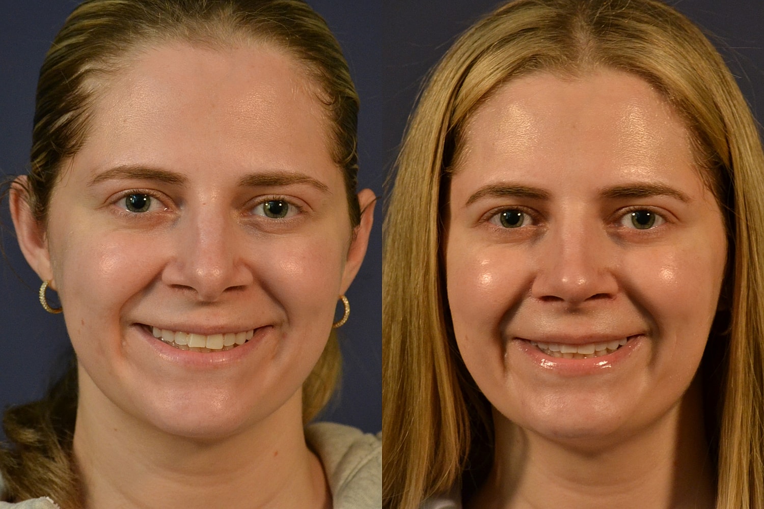 Rhinoplasty Before & After